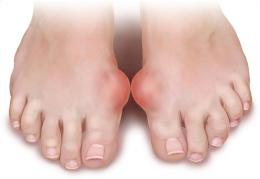 Ból dużego palca stopy - podagra, dna moczanowa 