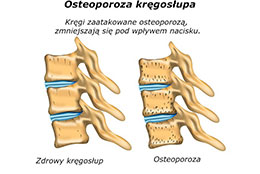Osteoporoza - jak leczyć? 