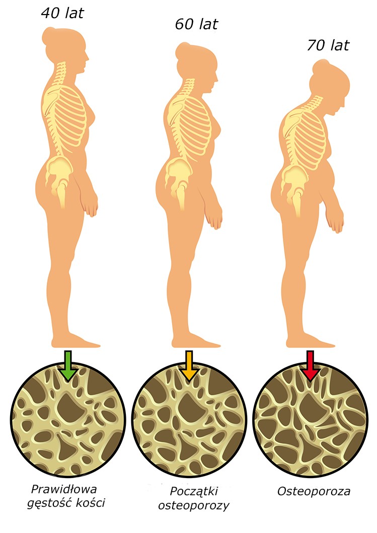 ortopeda osteoporoza kobieta