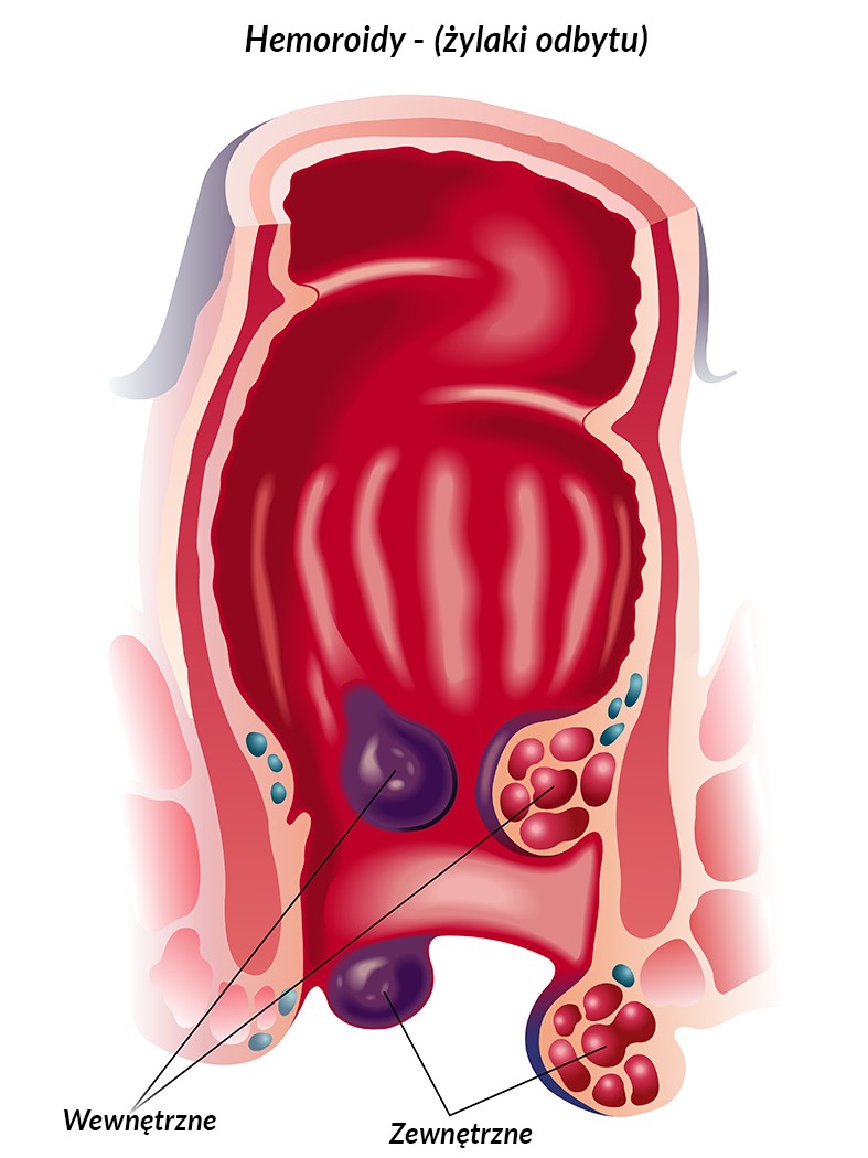 hemorrhoids-northern-virginia-gastroenterology