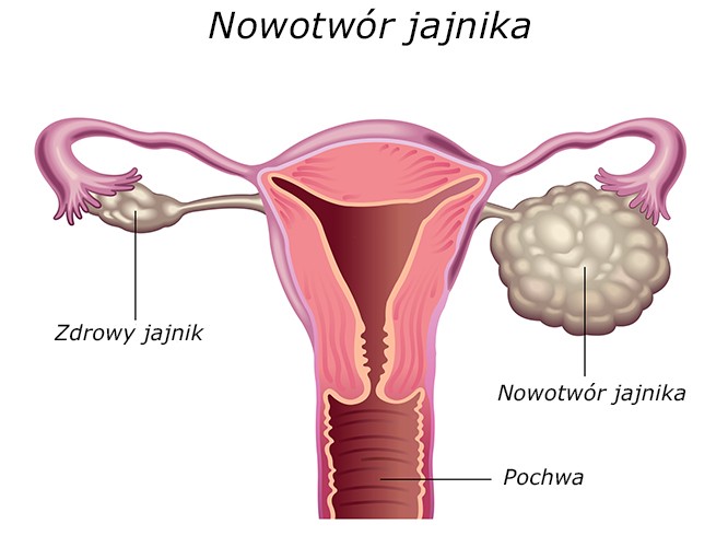 Nowotwór jajnika