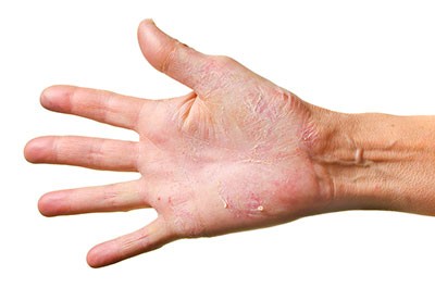 Egzema czy alergia skórna