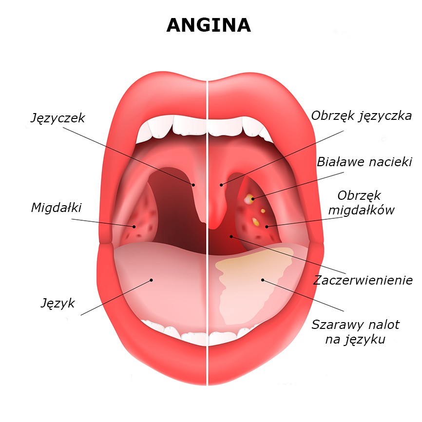 Angina