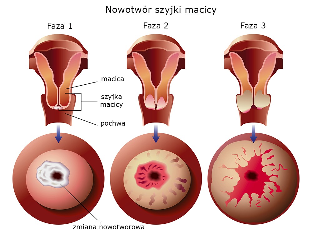 Nowotwór szyjki macicy