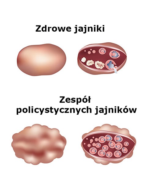 PCOS
