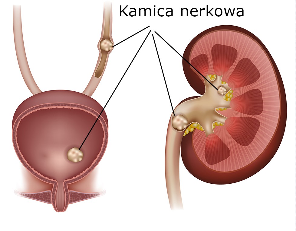 Kamica nerkowa