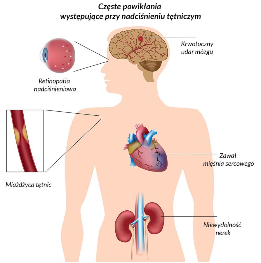 Nadciśnienie tętnicze