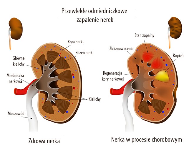 Zapalenie nerek
