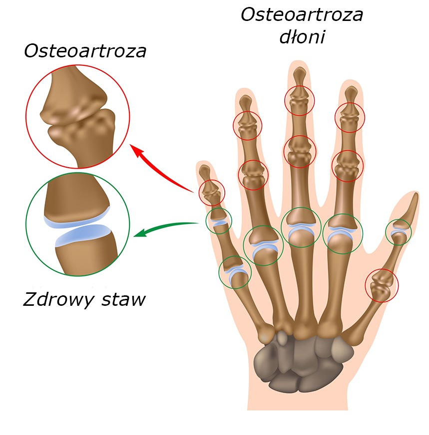 Osteoartroza dłoni