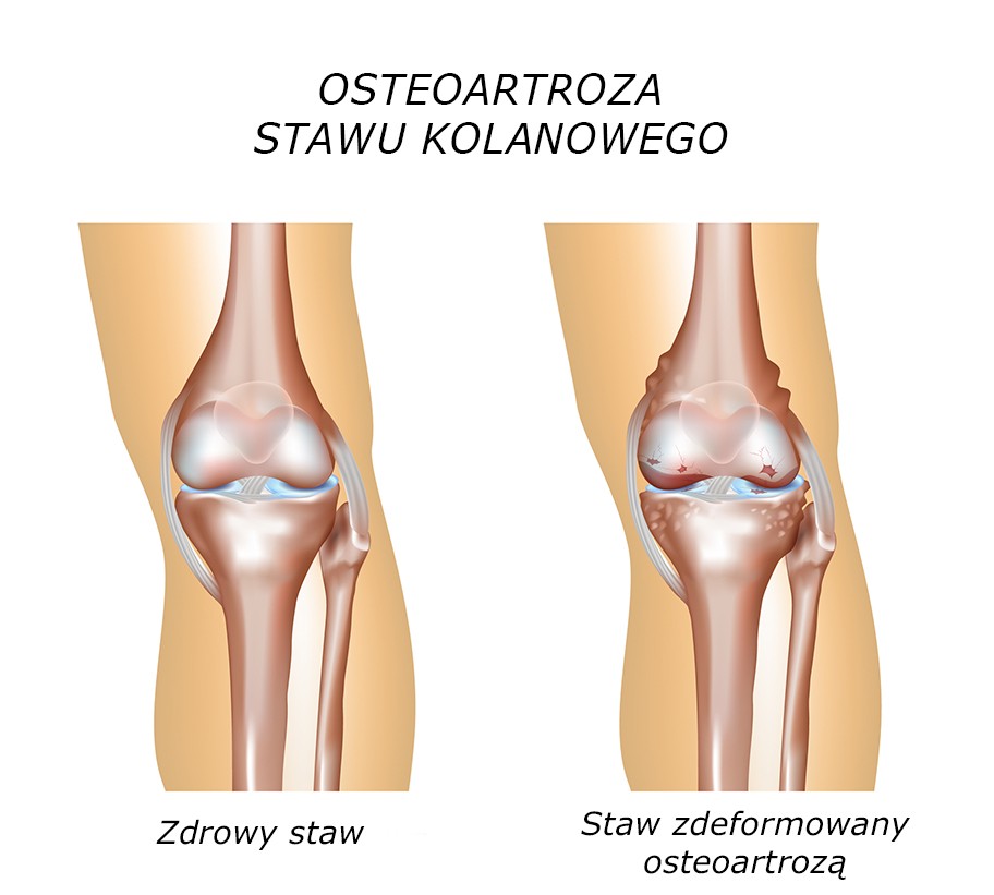 Osteoporoza stawu kolanowego