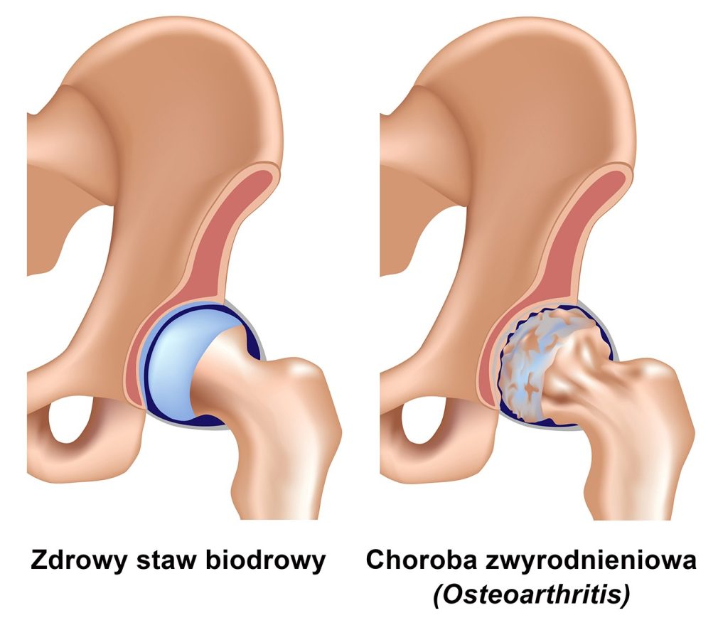 Choroba zwyrodnieniowa