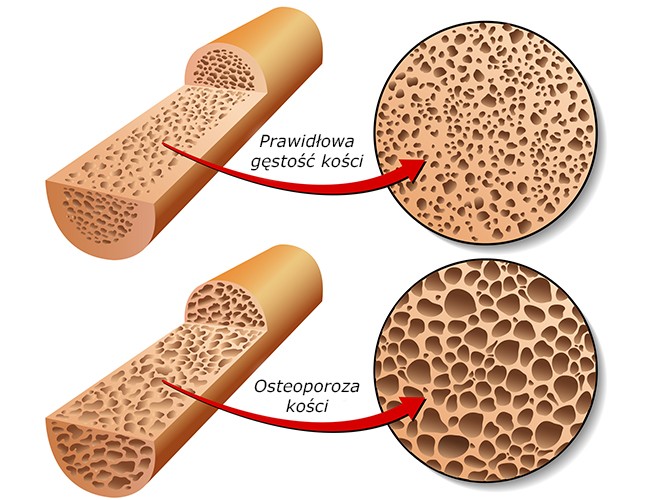 Osteoporoza kości