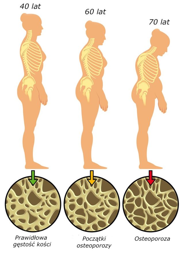 Osteoporoza kręgosłupa