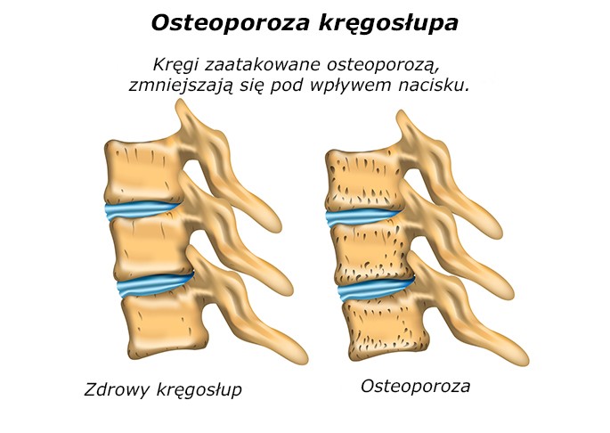 Osteoporoza
