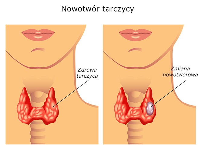 Rak tarczycy