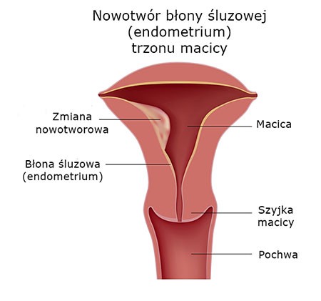 Nowotwór błony śluzowej