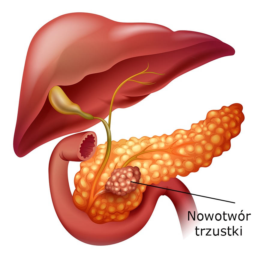 Nowotwór trzustki