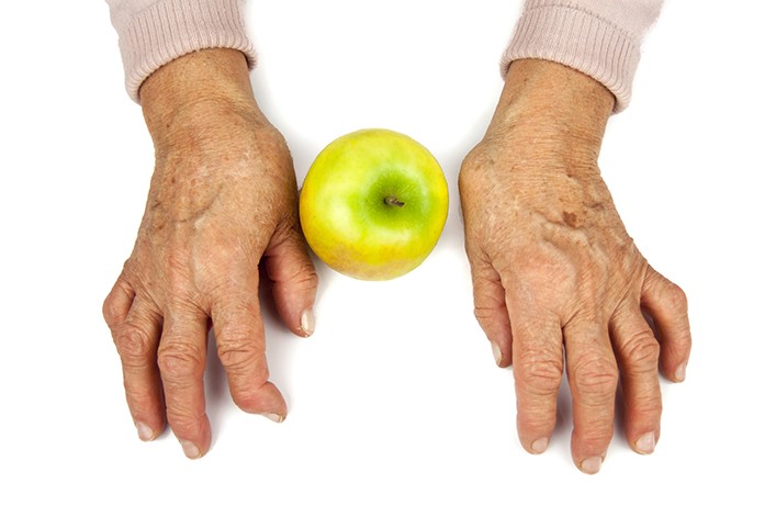 Zespół Sjogrena objawy
