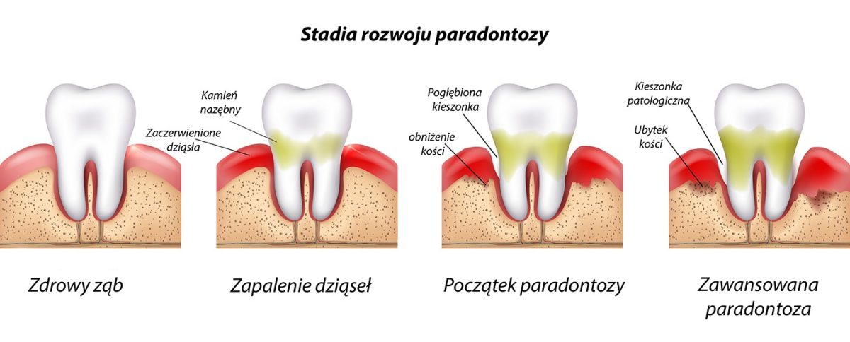 Stadia rozwoju paradontozy