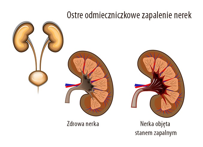 Odmiedniczkowe zapalenie nerek