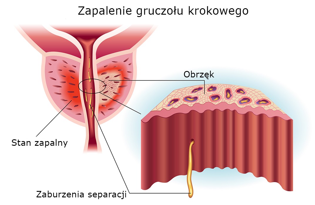 Zapalenie gruczołu krokowego