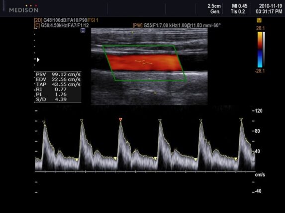 USG doppler